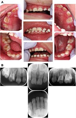 Case Report: Dental treatment under general anesthesia and dental management of a child with congenital ichthyosis